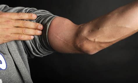 From Career Ending to Career Rebirth: The Tommy John Surgery